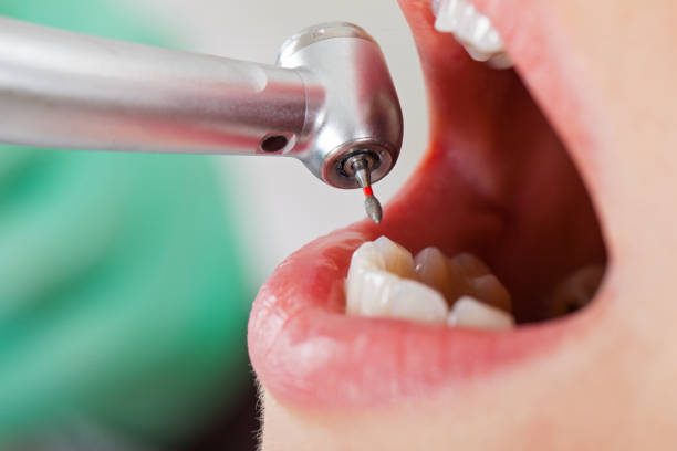 Best Emergency Wisdom Teeth Removal in Claypool Hill, VA